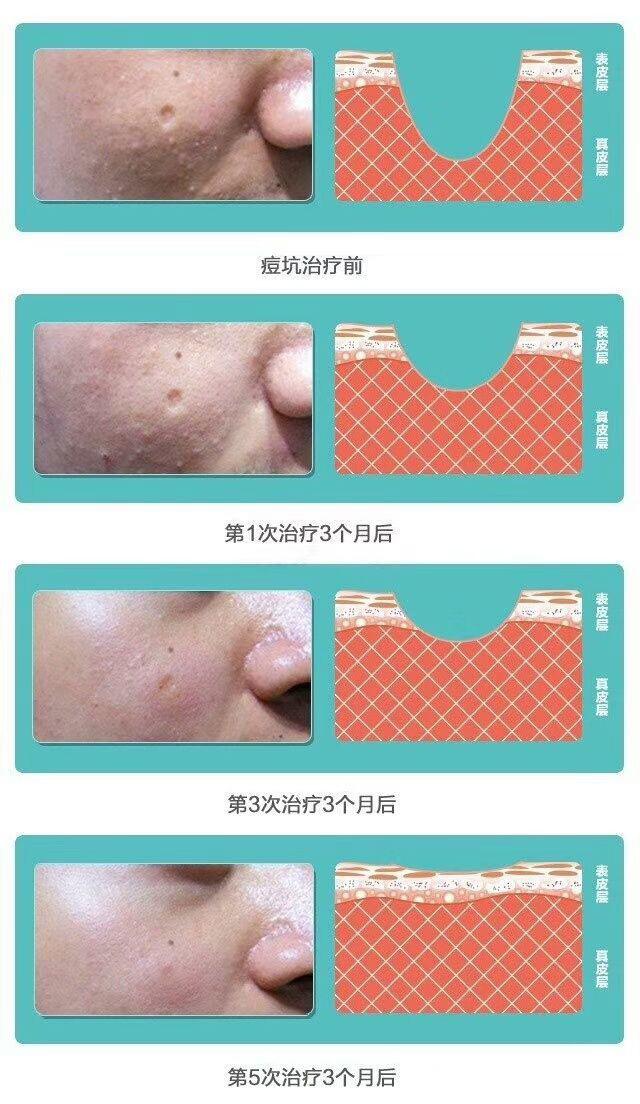 痘坑一辈子都不会好吗，激光祛痘印痘坑多少钱一次（能否选择‘’无恢复期‘’的治疗项目）
