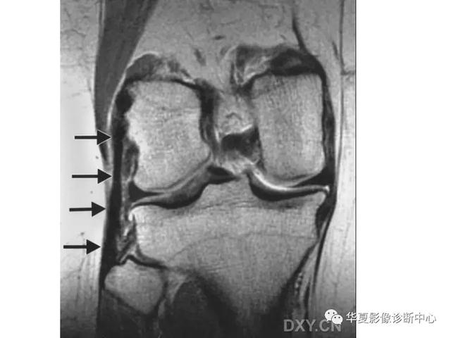 膝关节解剖结构图，膝盖解剖图示意图（膝关节MRI之正常解剖综述）