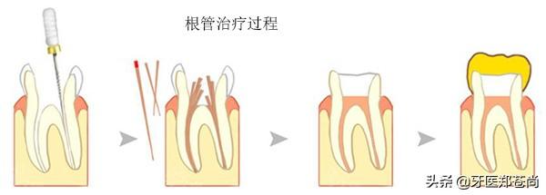 牙烂到什么程度要根管治疗，牙烂到什么程度要根管治疗儿童（蛀牙烂到神经，就要做根管治疗）