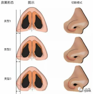 鼻翼收缩前后对比图，娜扎的鼻子怎么就歪掉了