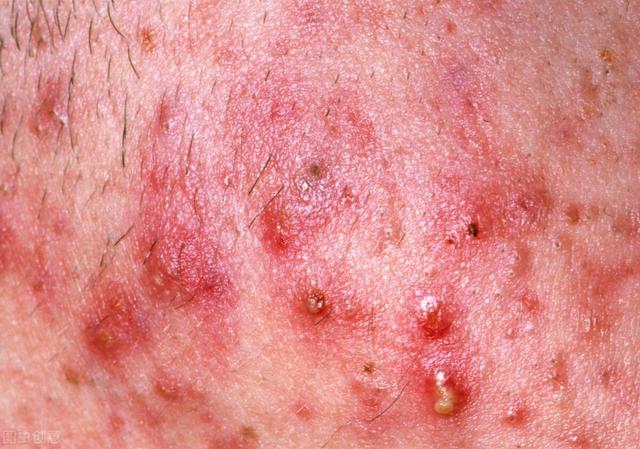 它会以黑头,丘疹,脓疱,结节,脓肿,囊肿和疤痕等多种皮肤损害的形式