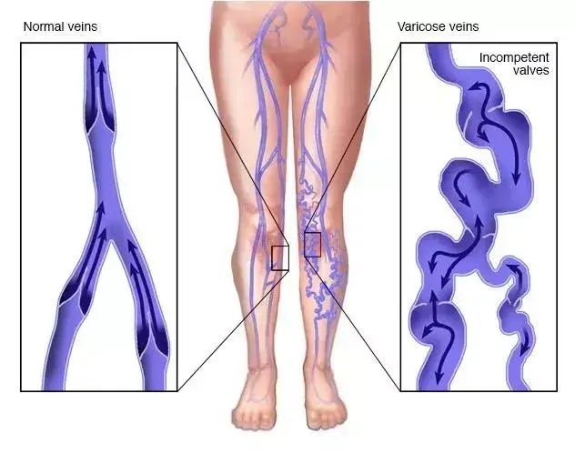 rf0 这种肝病的并发症你会治吗？一文读懂静脉曲张该怎么治