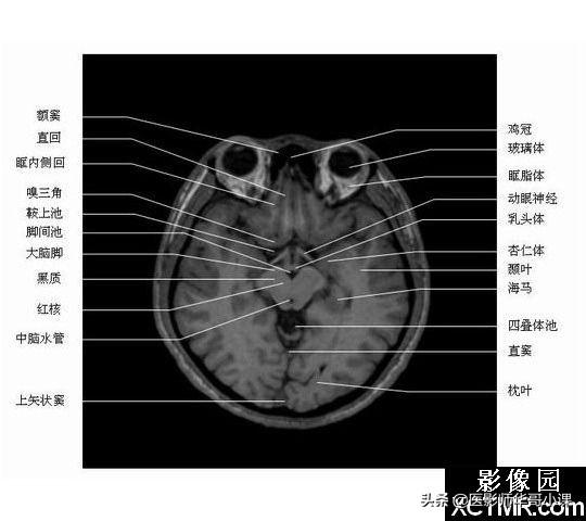 颅脑mri(头部MRI)插图(48)