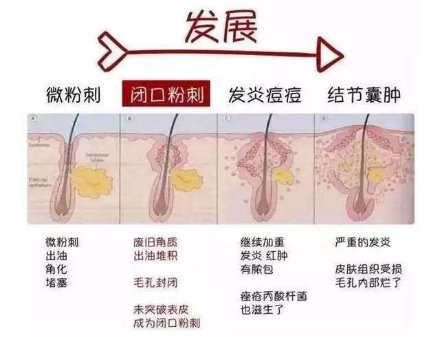 长闭口要怎么去除，脸上长闭口怎么去除（闭口反复长，如何去除有效）