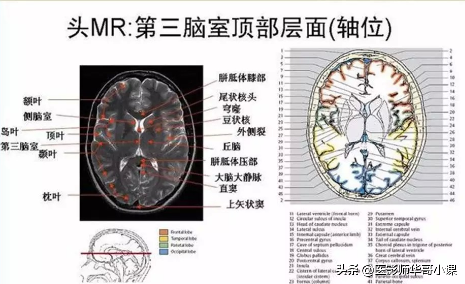 颅脑mri(头部MRI)插图(71)