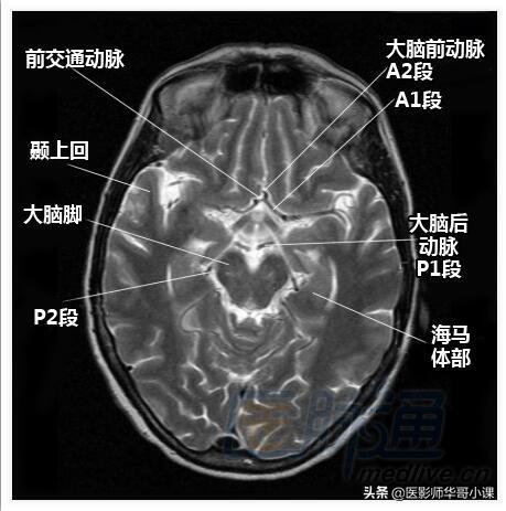 颅脑mri(头部MRI)插图(6)