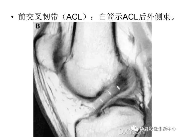 膝关节解剖结构图，膝盖解剖图示意图（膝关节MRI之正常解剖综述）