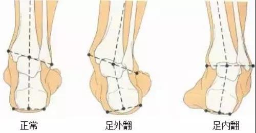 警惕宝宝足外翻，小孩子足外翻（足内翻或足外翻到底是什么）