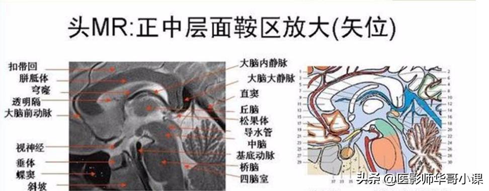 颅脑mri(头部MRI)插图(65)