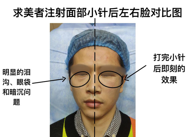怎样让泪沟快速消失，30岁小伙谈谈体验