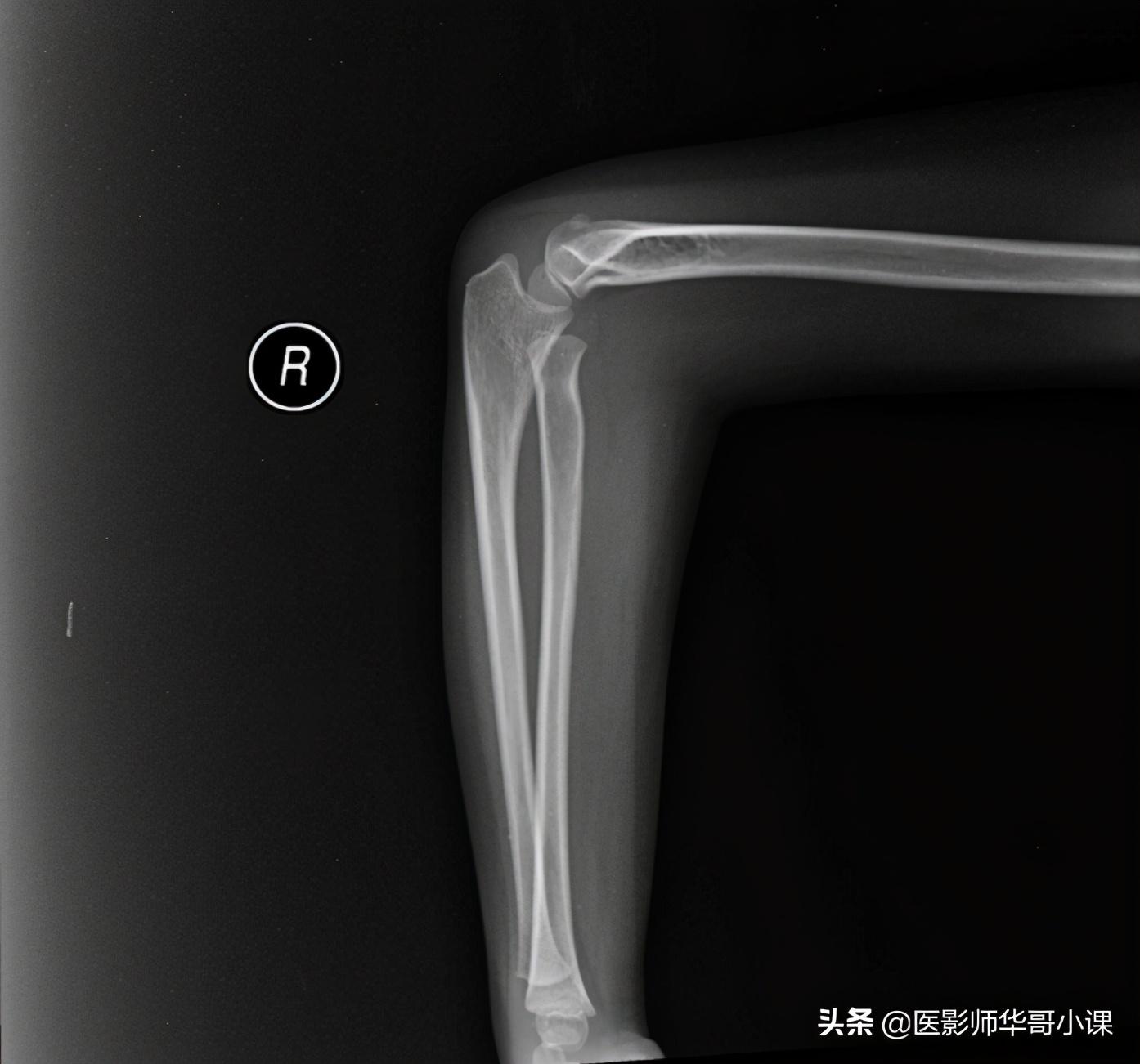 尺骨桡骨怎么区分，怎样分辨尺骨和桡骨（骨关节记忆要点，请收藏）