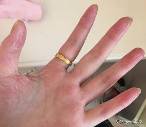 端,尤其是手指的两端,那就可以锁定两种疾病,即汗疱症与汗疱型癣菌病