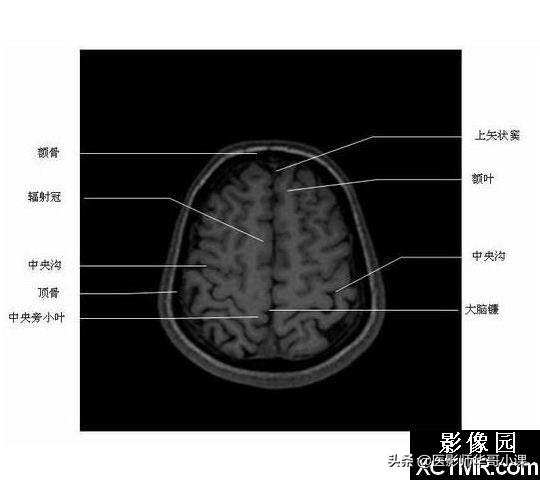 颅脑mri(头部MRI)插图(43)