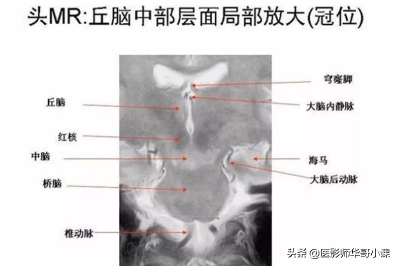 颅脑mri(头部MRI)插图(59)