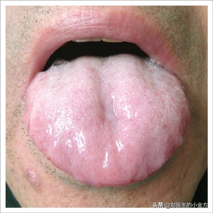 舌苔苔质:中根厚,边剥,腻,润;苔色:白,中根微黄.