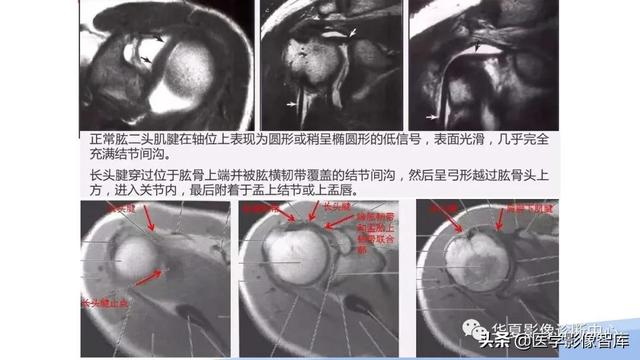 肩关节骨标志解剖图，全面掌握肩关节解剖