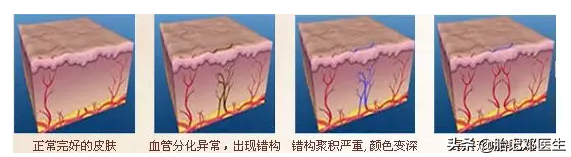 鲜红斑痣胎记是什么原因引起的，鲜红斑痣是怎形成的