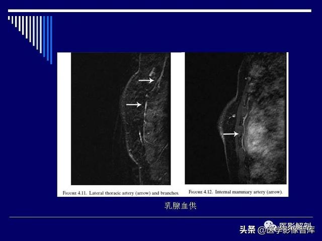 乳房解剖学基础知识，乳腺解剖及乳腺各病变影像诊断与鉴别