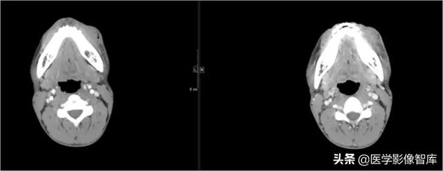 颞间隙感染，颞间隙感染切开部位（颌面部间隙感染影像诊断及各间隙解剖介绍）