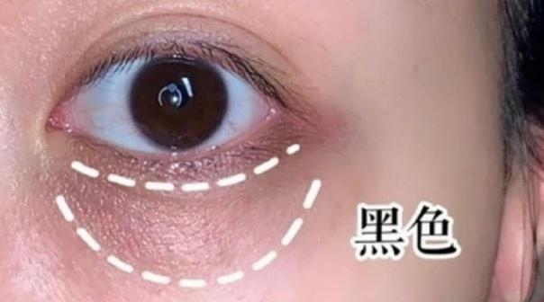 有黑眼圈怎么办，黑眼圈是什么原因（长了黑眼圈怎么办）