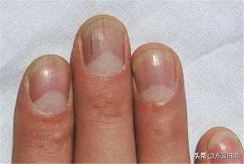 严重缺维生素指甲图片，指甲有这种情况小心癌症找上身（指甲出现黑纹需要注意了！）