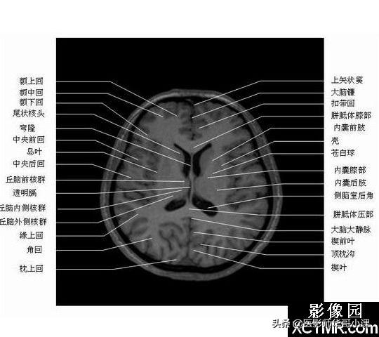 颅脑mri(头部MRI)插图(46)