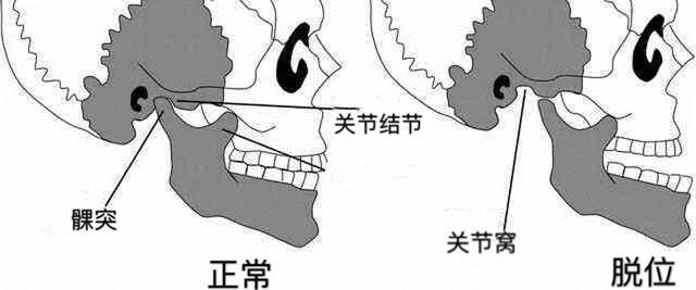 下巴掉了怎么复位，下巴闭口反复长怎么根治（下巴“掉”了怎么办）
