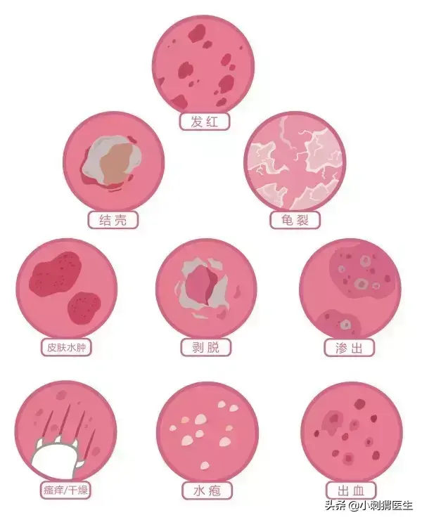 冰冻后的西瓜能吃吗，西瓜冻冰了还能吃吗（小强一样的皮疹）