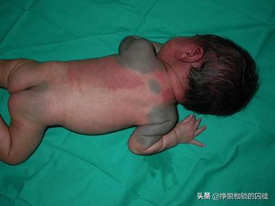 皮肤表面黑色素斑图片，皮肤各种斑的图片介绍（为什么小孩的屁股上的青斑叫蒙古斑）