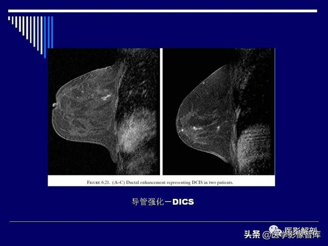 乳房解剖学基础知识，乳腺解剖及乳腺各病变影像诊断与鉴别