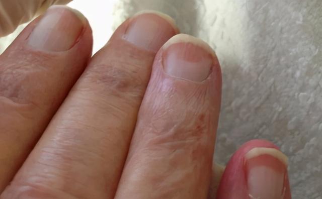 指甲盖凸起特别饱满的图片，手指盖上有凹坑怎么回事（是不同疾病的“求救信号”）