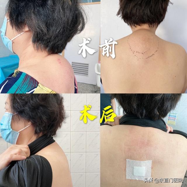 富贵包会自己消除吗 富贵包微创手术几天可以出院，富贵包会自己消除吗（东直门医院骨科外科联合研发微创可视化旋切技术治疗颈部富贵包）