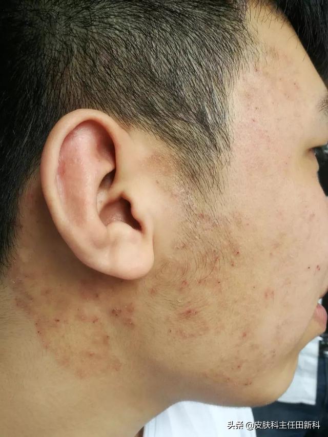 手上皮癣早期症状图片，皮癣的真实图片（你脸上成片“痘印”）