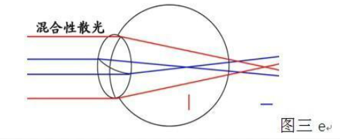 眼科cyl多少是正常，眼科cyl-1.25（镜片镜架选择总攻略）