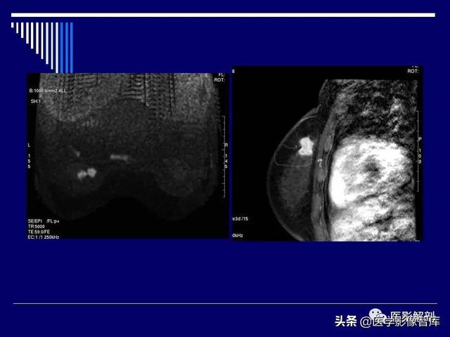 乳房解剖学基础知识，乳腺解剖及乳腺各病变影像诊断与鉴别