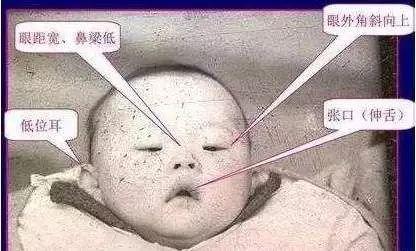 唐氏儿有哪些症状,唐氏综合征是怎么回事 - 玉三网