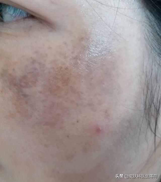 手臂上有咖啡色的斑图片，为何手臂上有很多暗沉的色斑（一文教你辨识自己长的究竟是啥斑）