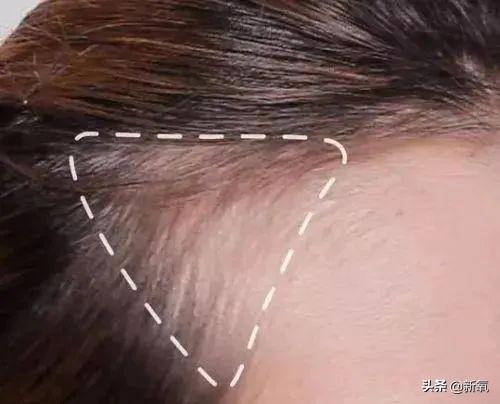 发际线粉会堵塞毛孔吗，发际线粉的危害（关晓彤才23岁就秃了）