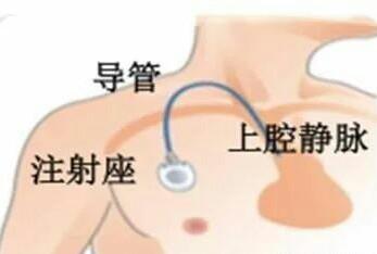 化疗埋管示意图，化疗时为什么要置PICC中心静脉导管、或埋输液港呢