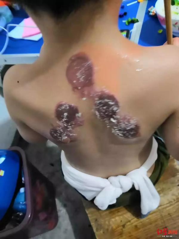 三伏贴的副作用，如何健康使用三伏贴（三伏贴致92名儿童出现不良反应）