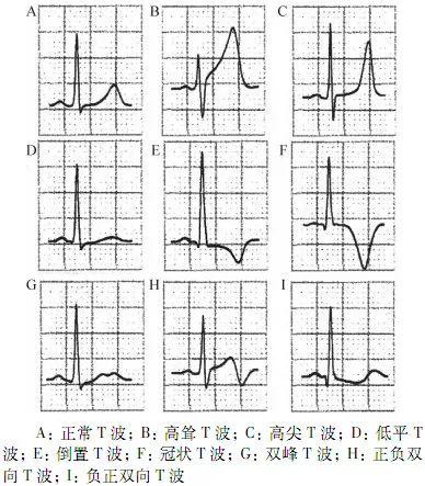 qtc间期正常值，心电图qt和qtc间期正常是多少毫秒