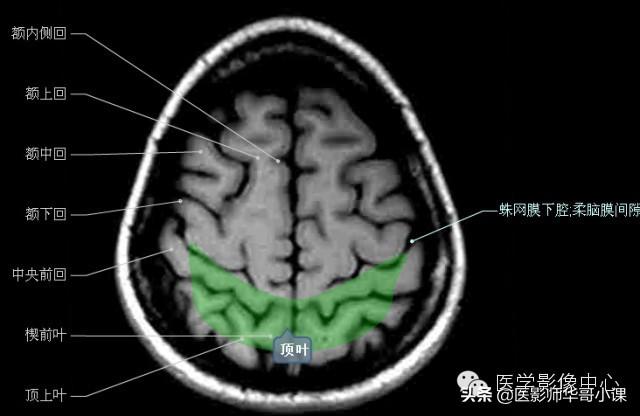 颅脑mri(头部MRI)插图(23)