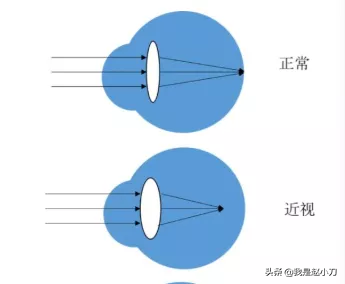近视镜是凸透镜还是凹透镜，老花镜是凸透镜还是凹透镜（近视不老花，老花不近视）