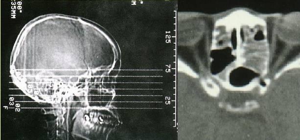 鼻窦炎微创手术，鼻窦炎微创手术价格是多少（诊治及【合理用药）