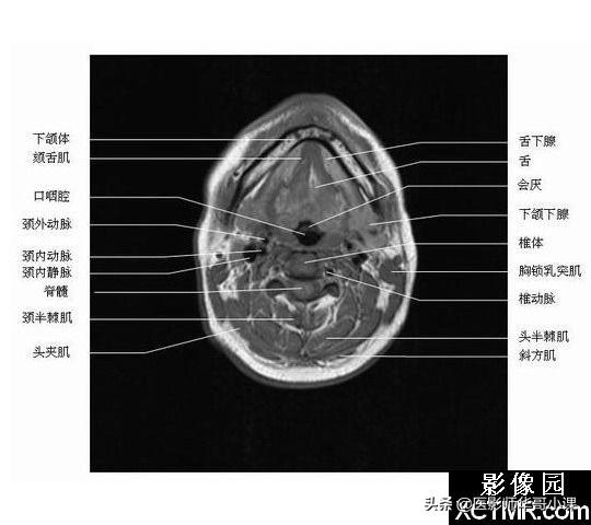 颅脑mri(头部MRI)插图(53)