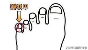 小脚趾甲两瓣是什么原因，为什么很多中国人小脚趾甲是两瓣的（很多中国人的小脚趾）