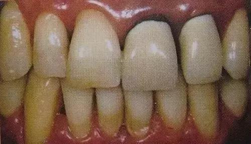 烤瓷牙是怎么做的，烤瓷牙是怎么做的伤牙吗（牙医教你如何选择烤瓷牙的材料）