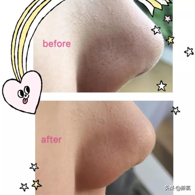 怎么去黑头小窍门，五个去黑头方法（我把火爆全网的去黑头方法试了一遍）