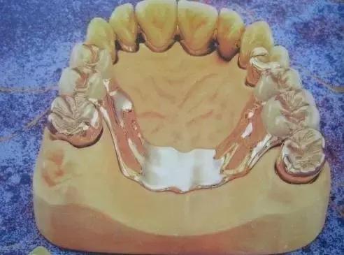 烤瓷牙是怎么做的，烤瓷牙是怎么做的伤牙吗（牙医教你如何选择烤瓷牙的材料）