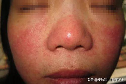 手上皮癣早期症状图片，皮癣的真实图片（你脸上成片“痘印”）